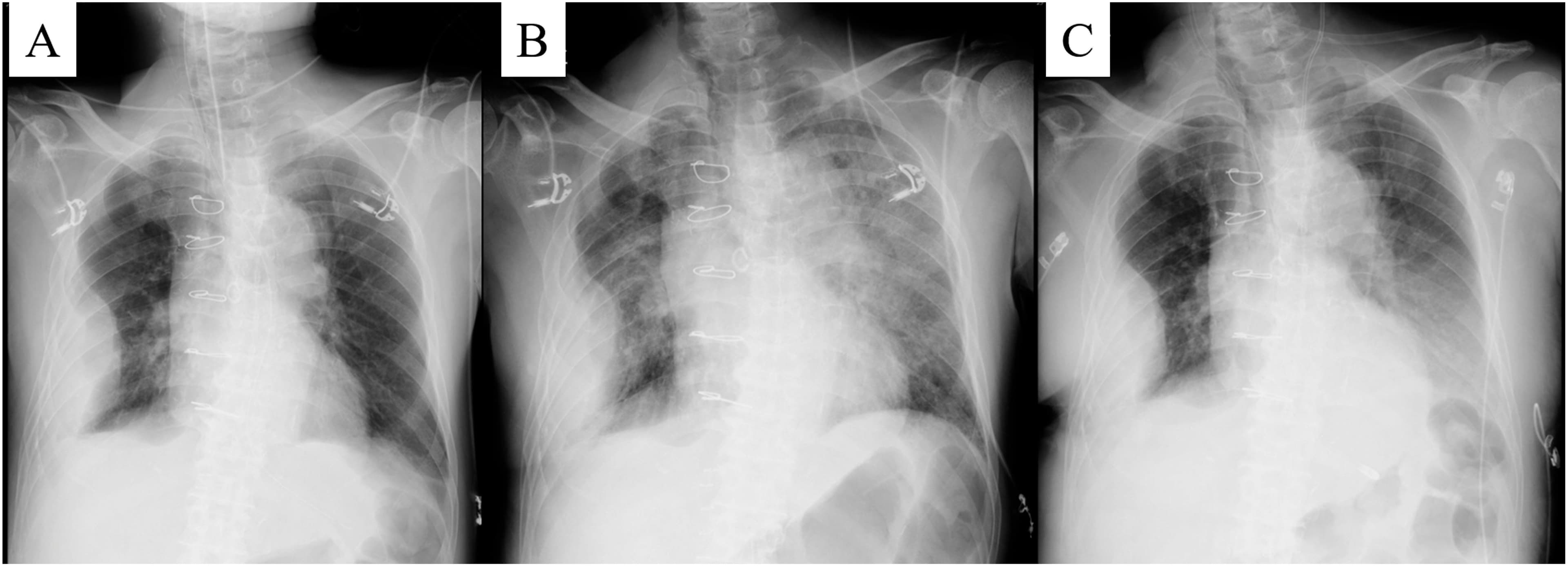 This sequence of three anteroposterior (AP) chest X-rays (labeled A, B, and C) demonstrates the longitudinal progression and resolution of acute pulmonary edema, consistent with Transfusion-Related Acute Lung Injury (TRALI). All images show sternotomy wires and surgical clips, indicating a post-thoracic surgery status. Image A (immediate postoperative) shows relatively clear lung fields with a stable nodular mass in the right middle zone. Image B (onset of respiratory distress) reveals a dramatic bilateral increase in diffuse, confluent alveolar and interstitial opacities, characteristic of pulmonary edema, with a stable cardiomediastinal silhouette. Image C (recovery phase) demonstrates significant clearing of the bilateral infiltrates and improved aeration of the lung parenchyma following treatment. The trachea remains midline and there is no evidence of cardiomegaly throughout the sequence, supporting a non-cardiogenic etiology for the pulmonary findings. These images serve as an educational example of rapid-onset pulmonary edema and its radiographic evolution in a critical care setting.