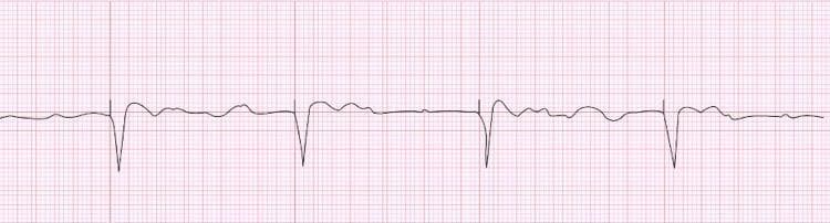 This diagnostic image is an electrocardiogram (ECG) rhythm strip illustrating a ventricular-paced rhythm in the context of complete atrioventricular (AV) block. The tracing shows prominent, regular, sharp downward deflections representing paced QRS complexes, each preceded by a clear vertical pacemaker spike. The ventricular pacing rate is approximately 30 beats per minute. Between these paced complexes, the baseline demonstrates independent atrial activity with small-amplitude, irregular P waves at a faster rate of approximately 80 beats per minute, confirming AV dissociation. The paced QRS complexes exhibit an amplitude of approximately 15-20 mm (3-4 large grid squares). This tracing serves as a clinical example of pacemaker function (VVI mode) and the electrophysiological manifestations of hyperkalemia-induced T-wave oversensing or conduction disturbances, necessitating device interrogation and electrolyte correction.
