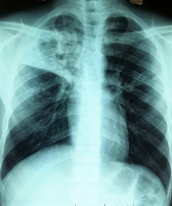 A posterior-anterior (PA) chest X-ray of an adult patient demonstrating significant pulmonary pathology. The most prominent finding is a large, poly-excavated (multi-cavitated) lesion in the right upper lobe. This cavity exhibits irregular, thickened walls with internal lucencies suggesting parenchymal destruction. The lesion appears to cross the midline or involve mediastinal structures, as evidenced by its contralateral extension. In the left lung, particularly within the hilar and axillary regions, there are visible micronodular and infiltrative opacities. These small, scattered densities suggest secondary spread or simultaneous involvement. The overall radiographic presentation is highly characteristic of advanced cavitary pulmonary tuberculosis or other chronic necrotizing infections. Key educational features include the demonstration of a 'destroyed lung' appearance and the distinction between large cavitary lesions and diffuse micronodular patterns (miliary or bronchogenic spread).