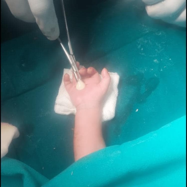 This clinical photograph captures an intraoperative scene of a surgical drainage procedure on a neonate's right hand. The image focuses on the palmar surface, where a longitudinal incision has been made to access the deep palmar space. A pair of surgical forceps is seen held by a gloved hand, facilitating the evacuation of thick, yellowish-white purulent material (pus) from the abscess site. The infant's hand rests on a sterile white gauze pad, which is positioned over a teal surgical drape. The surrounding skin of the palm and wrist appears slightly erythematous, consistent with localized inflammation secondary to a deep space infection. This visual demonstrates the management of neonatal hand infections, specifically the technique for incision and drainage of a palmar abscess. It serves as an educational example for pediatric surgery, infectious disease, and hand surgery specialties regarding the clinical presentation and surgical intervention of deep tissue neonatal infections.