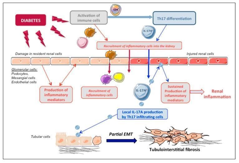 This pathophysiology diagram illustrates the mechanism of IL-17A-mediated renal injury in diabetic nephropathy. The flowchart originates with 'Diabetes' leading to two concurrent pathways: the activation of immune cells and damage to resident renal cells (podocytes, mesangial cells, and endothelial cells). The immune pathway details the differentiation of CD4+ T-lymphocytes into Th17 cells, which infiltrate the kidney and produce local IL-17A. This cytokine acts back on injured renal cells, triggering a feedback loop that leads to the sustained production of inflammatory mediators and chronic renal inflammation. At the cellular level, the diagram highlights the effect of local IL-17A on tubular epithelial cells, depicting a morphological transition labeled as 'Partial EMT' (Epithelial-to-Mesenchymal Transition). Here, structured cuboidal tubular cells transform into elongated, spindle-shaped mesenchymal cells associated with extracellular matrix deposition, ultimately culminating in tubulointerstitial fibrosis. The visual summarizes the interplay between metabolic stress, Th17-driven inflammation, and structural remodeling in the progression of diabetic kidney disease.