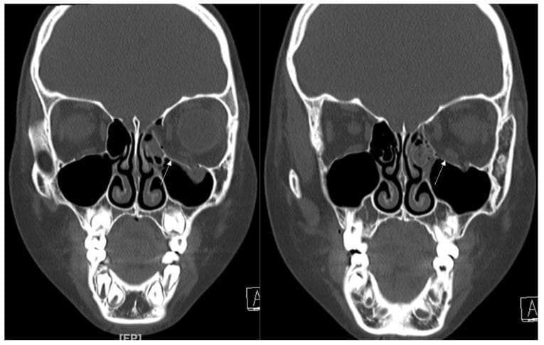 This diagnostic image consists of two coronal slices from a non-contrast facial CT scan of a pediatric patient, demonstrating a left-sided orbital blowout fracture. The images highlight the mid-facial anatomy, including the frontal bone, orbits, nasal cavity, ethmoid air cells, and maxillary sinuses. On the patient's right side, the orbital floor and medial wall are intact with clear sinus aeration. Conversely, the left side displays a significant discontinuity in the inferomedial orbital wall (white arrows), representing the fracture site. Visible pathology includes the displacement of bony fragments and the herniation of orbital contents (soft tissue) into the superior portion of the left maxillary sinus. There is also opacification of the adjacent left ethmoid air cells, suggestive of post-traumatic hemorrhage or mucosal edema. This imaging is clinically significant for diagnosing complex orbital fractures and assessing potential extraocular muscle entrapment in cases of facial trauma.