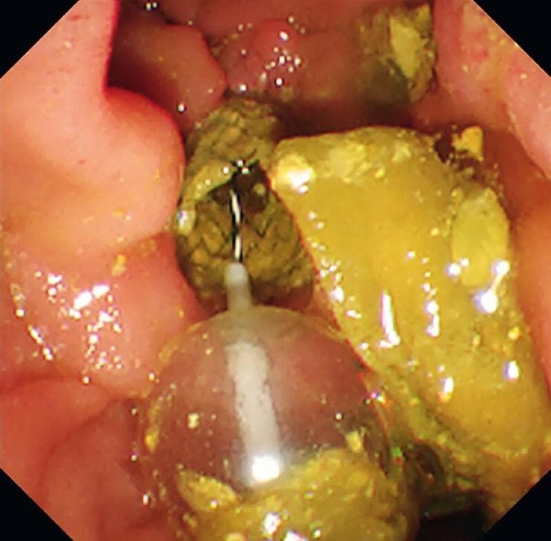 This endoscopic image provides a direct peroral cholangioscopy (DPOCS) view within a bile duct lumen, demonstrating a significant impaction of biliary sludge and food residue. In the foreground, an inflated, translucent balloon catheter is positioned to perform a 'balloon sweep' for ductal clearance. Extending from the catheter's tip is a thin metallic guidewire. The luminal space is occupied by heterogeneous materials: soft, yellowish, pasty debris characteristic of food impaction and sludge, alongside darker, brownish-green solid fragments. The surrounding bile duct wall appears erythematous and edematous, consistent with acute cholangitis. This visual captures a critical step in managing recurrent biliary obstruction (RBO) following self-expandable metallic stent (SEMS) placement, where clearance of the ductal lumen is required before secondary procedures, such as the placement of a dual anti-reflux metal stent (D-ARMS), to prevent early stent dysfunction caused by refluxed duodenal contents.