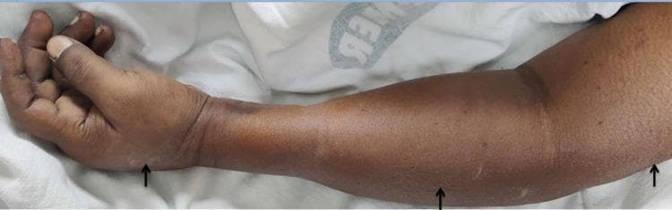 Clinical photograph of a left upper limb demonstrating generalized edema and localized areas of subcutaneous emphysema. The image captures the limb from the hand to the upper arm, showing significant diffuse swelling that distends the anatomical contours. Black arrows highlight specific regions of subcutaneous air accumulation, manifesting as visible puffiness and uneven skin texture over the thenar eminence of the hand, the mid-forearm, and the proximal upper arm. A dark, ecchymotic patch is visible on the dorsal aspect of the wrist joint. This visual finding is characteristic of soft tissue air infiltration, which clinically presents with palpable crepitus. The image serves as a teaching tool for recognizing non-traumatic or traumatic subcutaneous emphysema and the resulting alteration in limb morphology and skin surface integrity in an acute clinical setting.