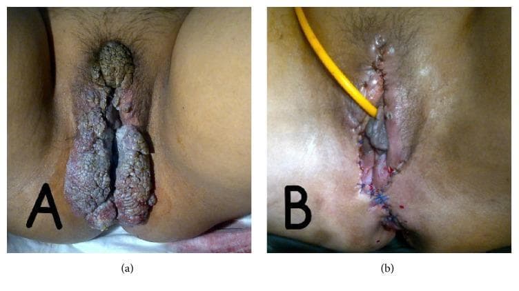 Two-panel clinical photograph demonstrating condyloma acuminata (genital warts) and its surgical management in a patient with systemic lupus erythematosus. Image (a) shows extensive, multifocal, hypertrophic verrucous lesions involving the vulva, perineum, and perianal region. The lesions exhibit a classic 'cauliflower-like' morphology with a rough, filiform texture and varied pigmentation ranging from skin-toned to brownish-grey. Image (b) shows the same anatomical region post-surgical excision. The surgical site features approximated skin edges secured with blue interrupted sutures extending through the labia and perineum. A yellow drainage tube is positioned for fluid management. Evidence of post-operative erythema and inflammation is visible. This comparison illustrates the clinical manifestation of severe HPV-related verrucous disease in an immunocompromised state and the immediate results of surgical debulking and reconstruction.