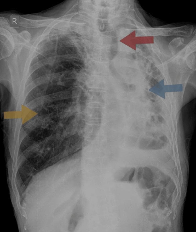 This chest X-ray (posteroanterior view) demonstrates significant pulmonary pathology consistent with left lung collapse and architectural distortion, likely as a sequela of pulmonary tuberculosis. Key findings include an opaque left hemithorax with a marked loss of volume (blue arrow), causing a significant ipsilateral shift of the mediastinum and trachea (red arrow). The ribs on the left side appear crowded, further reflecting the volume loss. In contrast, the right lung shows signs of compensatory hyperinflation (yellow arrow), evidenced by increased radiolucency and expanded volume to compensate for the contralateral dysfunction. The cardiac silhouette is obscured by the mediastinal shift and left-sided opacification. This radiological presentation is characteristic of chronic fibro-cavitary changes or total lung collapse, frequently observed in advanced or treated tuberculosis cases, and illustrates the physical pull exerted by parenchymal destruction and scarring on midline structures.