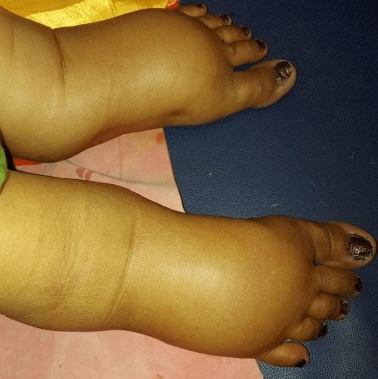 Clinical photograph showing severe, bilateral pedal edema in a pregnant patient. The image displays the dorsum of both feet and the ankles, which exhibit significant swelling characterized as grade 3 pitting edema. There is a notable loss of normal anatomical landmarks, with the bony prominences of the medial and lateral malleoli completely obscured by fluid accumulation. The skin appears stretched, shiny, and demonstrates a slight yellowish discoloration. The swelling extends from the toes to the lower legs, with visible distension of the soft tissues. This finding is clinically relevant in the context of systemic diseases during pregnancy, such as preeclampsia or infectious etiologies like leptospirosis, as it indicates significant fluid retention and potential multi-organ involvement.