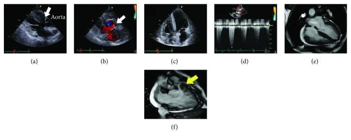 This composite figure presents multi-modal cardiac imaging of a patient with Tetralogy of Fallot. Panels (a) through (d) utilize transthoracic echocardiography: (a) Parasternal long-axis view showing a large subaortic ventricular septal defect (VSD, white arrow) with an overriding aorta. (b) Color Doppler confirms bidirectional shunting across the VSD. (c) Apical four-chamber view demonstrating marked right ventricular (RV) hypertrophy. (d) Spectral Doppler showing significant RV outflow tract (RVOT) obstruction with a high-velocity jet of 4.9 m/s. Panels (e) and (f) display Cardiac Magnetic Resonance Imaging (CMRI): (e) 4-chamber cine image used for volumetric analysis showing RV enlargement. (f) Detailed CMRI of the RVOT (yellow arrow) identifying severe infundibular (subvalvular) pulmonary stenosis. Collectively, these images illustrate the classic anatomical components of Tetralogy of Fallot including VSD, overriding aorta, RV hypertrophy, and RVOT obstruction, emphasizing the importance of multimodality imaging in assessing congenital heart disease.