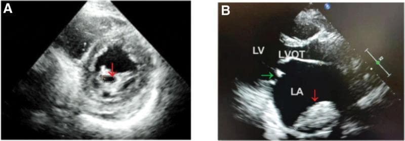 Two-panel transthoracic echocardiogram (TTE) demonstrating classic cardiac complications of Rheumatic Heart Disease (RHD). Panel A shows a short-axis view at the level of the mitral valve, where a red arrow highlights a stenotic mitral valve orifice. The valve leaflets appear significantly thickened with increased echogenicity, characteristic of fibrotic or calcific changes. Panel B displays a parasternal long-axis view showing severe left atrial (LA) enlargement, a common sequela of mitral stenosis. Within the dilated LA, a red arrow identifies a large, echogenic, and heterogeneous mass consistent with an intracavitary thrombus. A green arrow indicates the mitral valve apparatus between the LA and the left ventricle (LV). The image provides a clinical demonstration of the structural remodeling and thromboembolic risks associated with chronic rheumatic mitral valve disease, particularly in the context of atrial fibrillation.