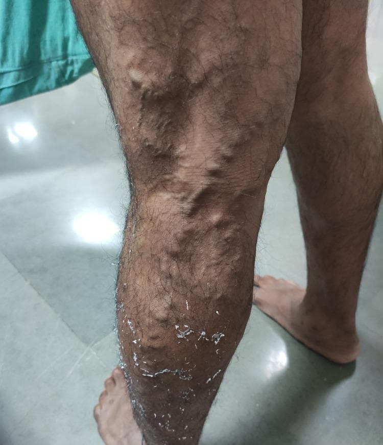 This clinical photograph displays a 50-year-old male's left lower limb with extensive varicose veins. The affected veins are highly tortuous, dilated, and exhibit a prominent, rope-like bulging appearance characteristic of Chronic Venous Insufficiency (CVI). The distribution is primarily located along the anterior and medial aspects of the distal thigh and proximal lower leg. Multiple interconnected, distended venous segments are visible beneath the skin's surface. Additionally, the lower portion of the leg shows secondary skin changes including visible dryness, scaling, and white flakiness, which can be associated with venous stasis dermatitis or the residue of topical treatments. This image serves as a textbook example of CEAP classification grade C2 (varicose veins) and illustrates clinical manifestations often assessed using the Venous Clinical Severity Score (VCSS).