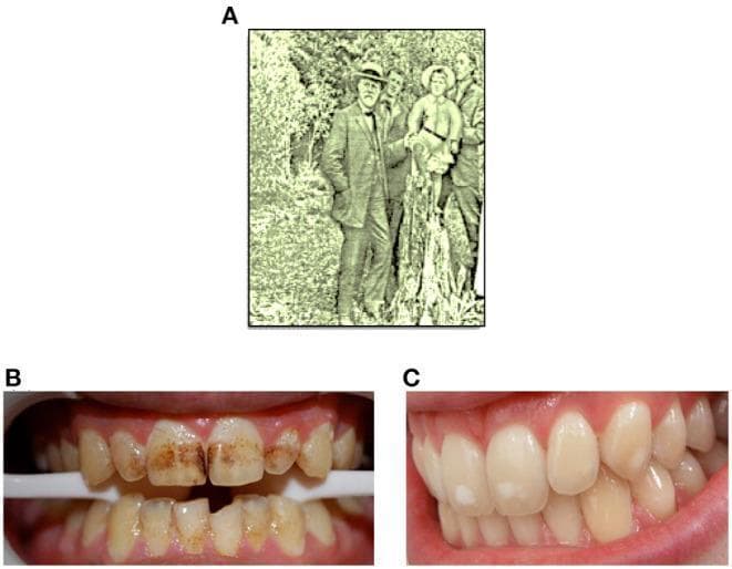 A multi-panel figure illustrating the history and clinical presentation of dental fluorosis. Panel A is a historical photograph from 1909 depicting Dr. G.V. Black in Colorado Springs. Panels B and C are clinical intraoral photographs showing different severities of enamel hypomineralization, historically termed 'mottled enamel.' Panel B demonstrates a severe case with 'Colorado brown stain,' characterized by prominent, intrinsic dark brown to tan discolorations and surface irregularities distributed across the labial surfaces and incisal edges of both maxillary and mandibular anterior teeth. Panel C shows a milder form of fluorosis, presenting as localized opaque white spots and diffuse cloud-like areas (mottling) on otherwise smooth and glossy enamel, indicating altered translucency without significant pitting or dark staining. This figure serves as an educational comparison between severe extrinsic-like staining and mild enamel opacities associated with chronic fluoride exposure during tooth development.