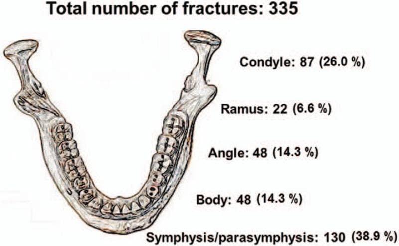 Anatomical diagram and statistical infographic depicting the distribution of 335 mandibular fractures across various anatomical locations in the human jaw. The illustration provides a superior-view sketch of the mandible including the dentition, condyles, and ramus. Quantitative data labels identify five key fracture sites with their respective frequencies and percentages: Symphysis/parasymphysis (130 cases, 38.9%), Condyle (87 cases, 26.0%), Angle (48 cases, 14.3%), Body (48 cases, 14.3%), and Ramus (22 cases, 6.6%). This infographic serves as an educational tool for oral and maxillofacial surgery and emergency medicine, highlighting the symphysis/parasymphysis as the most frequent site of injury and the ramus as the least frequent. It characterizes common patterns of mandibular trauma, often associated with mechanisms such as motor vehicle accidents or interpersonal violence.