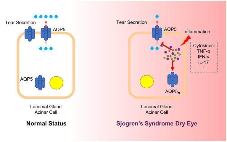 This pathophysiology diagram illustrates the dysregulation of Aquaporin 5 (AQP5) in lacrimal gland acinar cells during Sjögren’s Syndrome Dry Eye (SSDE) compared to normal status. On the left, 'Normal Status' shows AQP5 channels primarily localized at the apical membrane, facilitating robust water transport (blue droplets) and tear secretion. On the right, 'Sjögren’s Syndrome Dry Eye' depicts chronic inflammation driven by cytokines (TNF-α, IFN-γ, and IL-17). These inflammatory mediators cause a distinct mislocalization of AQP5 from the apical membrane to basolateral and cytoplasmic regions, indicated by red arrows. This structural shift leads to reduced AQP5 expression at the apical surface and inhibited fluid transport, visually represented by blocked secretion pathways and sparse tear droplets. The comparison highlights how autoimmune-driven inflammation disrupts cellular polarity and water channel trafficking, providing a mechanistic explanation for the ocular dryness characteristic of Sjögren’s Syndrome.