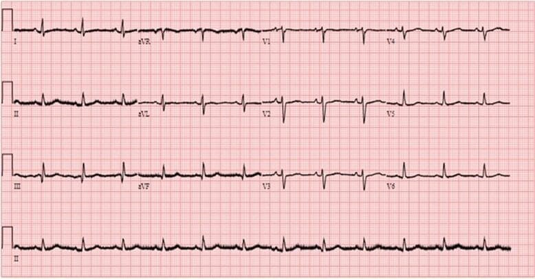 A standard 12-lead electrocardiogram (ECG) recording displayed on a red-lined grid paper. The image represents diagnostic cardiology imaging from a post-operative follow-up. The tracing demonstrates normal sinus rhythm characterized by consistent P waves preceding every QRS complex, normal PR intervals, and regular R-R intervals. The 12 leads (I, II, III, aVR, aVL, aVF, V1-V6) are organized into four columns, with a long rhythm strip of Lead II at the bottom. Waveform morphologies show appropriate axis and progression, including positive P waves in leads I and II, an inverted aVR, and normal R-wave progression across the precordial leads (V1-V6). QRS complexes and T waves appear within normal limits for duration and amplitude, with no evidence of acute ischemia, significant ST-segment deviation, or conduction abnormalities. This clinical photograph serves as an educational example of baseline cardiac electrical activity and post-surgical recovery monitoring.