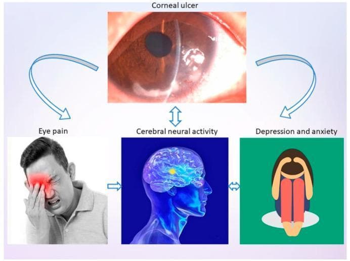 This infographic presents a pathophysiology diagram and clinical imagery illustrating the systemic impact of a corneal ulcer (CU). The central figure is a slit-lamp photograph labeled 'Corneal ulcer,' showing a localized, whitish opacity in the inferior-nasal quadrant of the cornea with irregular surface texture and loss of transparency, indicating tissue necrosis or infiltrate. Arrows connect this primary ophthalmic condition to three secondary clinical consequences: 'Eye pain,' 'Cerebral neural activity,' and 'Depression and anxiety.' The 'Eye pain' panel features a clinical photograph of a man demonstrating photophobia and distress, manually shielding his eye. The 'Cerebral neural activity' panel contains a medical illustration of a human brain with highlighted regions in the frontal lobe, suggesting changes in functional connectivity or degree centrality. The 'Depression and anxiety' panel uses a symbolic illustration of a person in a fetal position to represent psychological comorbidity. The diagram summarizes the relationship between local ocular pathology and broader neurological and psychological outcomes in ophthalmology.