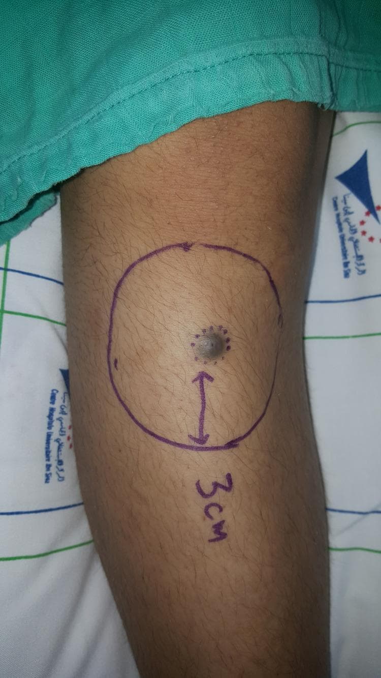 A clinical photograph of a patient's leg showing a preoperative view of a suspected malignant skin lesion, later identified as nodular melanoma. The primary lesion is a centrally located, dark-pigmented, nodular mass with irregular surface morphology. Surrounding the central nodule are several satellite dot-like pigmented spots. Surgical planning markings in purple ink delineate a planned 3 cm wide local excision margin, represented by a large circular boundary with an internal radial arrow and the text '3 cm' indicating the distance from the tumor edge. The surrounding skin appears normal with typical hair follicle distribution. This image illustrates the standard preoperative marking process for managing high-risk cutaneous malignancies to ensure clear histopathological margins.