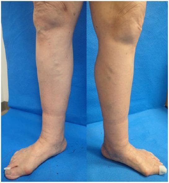 Clinical photograph of the lower extremities of a 79-year-old female presenting with bilateral lower leg edema. The image displays a side-by-side view of the left and right legs from the knee to the foot. Key findings include diffuse non-pitting edema primarily localized below the knees, most prominent in the calf and ankle regions, resulting in an increased limb circumference and a taut, shiny skin appearance. Prominent varicose veins are visible along the medial aspect of both legs, with greater severity noted on the left. The clinical presentation is consistent with CEAP classification grade C3 (venous edema) and secondary lymphedema, indicated by the loss of normal anatomical contours at the ankles. These visual features are characteristic of chronic venous insufficiency and comorbid lymphatic drainage impairment (phlebolymphedema). This material is intended for instruction on vascular assessment, clinical grading of chronic venous disease, and the differential diagnosis of lower extremity swelling.
