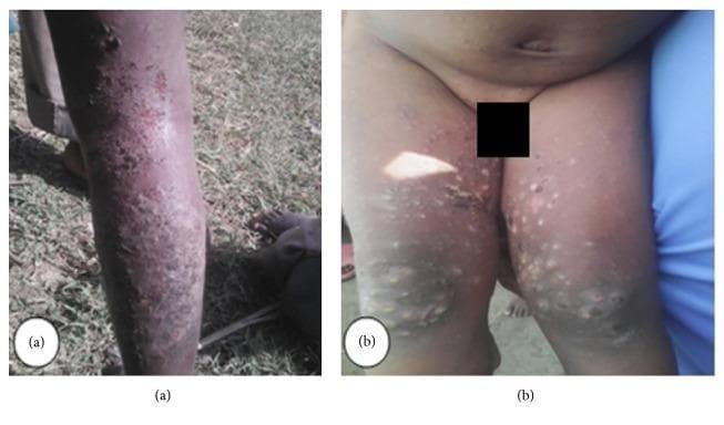 Two clinical photographs (a and b) demonstrating dermatological manifestations of a scabies infestation in human patients. Image (a) presents the posterior view of a lower leg, showing a widespread, dense distribution of small, erythematous papules and patches. The rash covers the calf and ankle regions with evidence of excoriations and crusting, suggesting secondary bacterial infection or intense pruritus. Image (b) shows the intergluteal region and posterior thighs of a child. This view exhibits a polymorphous eruption consisting of scattered papules, larger nodules, and pustular lesions. Some lesions show signs of inflammation and hyperpigmentation. The distribution is characteristic of scabies, frequently involving skin folds and areas of contact. These images illustrate the typical clinical presentation of sarcoptic mange (scabies) in a community outbreak setting, highlighting common complications such as secondary impetiginization and extensive cutaneous involvement.