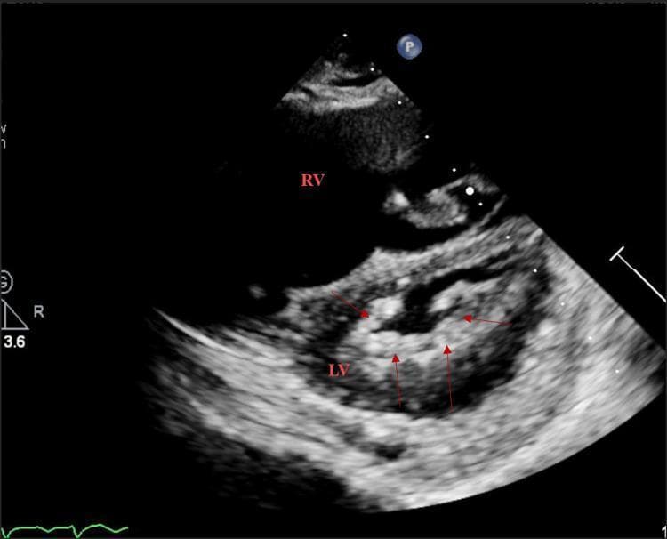 This diagnostic image is a transthoracic echocardiogram in the parasternal short-axis (PSAX) view at the mitral valve level. The image depicts the characteristic cross-sectional anatomy of the heart, showing the right ventricle (RV) positioned anteriorly and the circular left ventricle (LV) containing the mitral valve apparatus. Key pathology is highlighted by red arrows, which indicate diffuse, echogenic thickening of the mitral valve leaflets and surrounding tissue. The mitral orifice is notably restricted and narrowed, a classic visual feature of mitral stenosis, likely of rheumatic etiology given the extent of commissural fusion and leaflet thickening. The LV myocardium displays a typical grainy texture on point-of-care ultrasound (POCUS). This visual is highly relevant for medical education regarding valvular heart disease, specifically demonstrating the morphological changes observed in chronic rheumatic mitral stenosis and the use of echocardiography for assessing cardiac valve orifice patency.