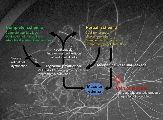 This medical schematic overlaid on an ultra-widefield fluorescein angiogram (FA) illustrates the pathophysiology of Macular Edema (ME) resulting from Branch Retinal Vein Occlusion (BRVO). The diagram categorizes the consequences of 'Vein occlusion' into mechanical and ischemic pathways. The mechanical pathway involves increased hydrostatic pressure and blood flow stagnation leading directly to 'Mechanical vascular leakage' and subsequent 'Macular edema'. The ischemic pathway distinguishes between 'Partial ischemia' (characterized by capillary dropout, microaneurysms, and telangiectactic change) and 'Complete ischemia' (characterized by complete capillary loss and vessel obstruction). Partial ischemia primarily drives 'Cytokine production'—including VEGF and inflammatory cytokines—which causes vascular hyperpermeability and ME. In contrast, complete ischemia leads to 'Severe retinal cell dysfunction', contributing less to cytokine production. A feedback loop is depicted where elevated cytokines promote 'Leukostasis' and 'Intraluminal proliferation of endothelial cells', potentially progressing partial ischemia into complete ischemia. The background FA demonstrates retinal vasculature with areas of hypofluorescence representing non-perfusion typical of occlusive retinopathy.