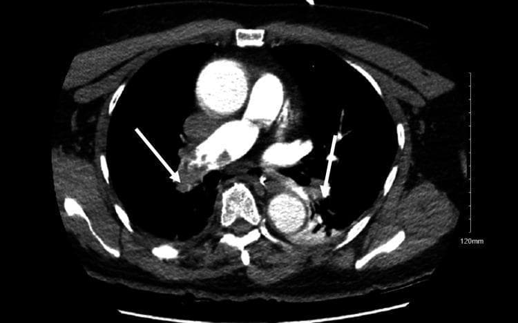 This diagnostic image is an axial contrast-enhanced CT Pulmonary Angiography (CTPA) of the chest. It demonstrates significant bilateral acute pulmonary emboli within the pulmonary arterial tree. Key findings include prominent, low-attenuation filling defects (darker regions) contrasted against the bright, opacified blood in the pulmonary arteries. Specifically, white arrows highlight large clots obstructing the main right and left pulmonary arteries, consistent with a saddle embolus configuration. Smaller peripheral filling defects are also visible in the branching segments of the arterial tree. Other visible thoracic structures include the ascending and descending aorta, the heart, and the superior vena cava, which show normal contrast enhancement. The image serves as a clinical illustration of massive pulmonary embolism causing significant vascular obstruction, often associated with hemodynamic instability and right ventricular strain in an acute clinical setting.
