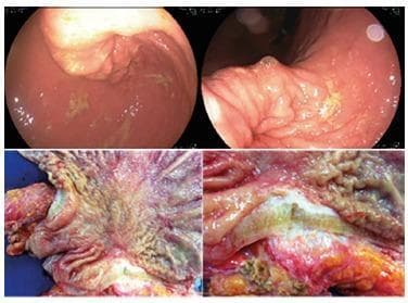 This composite figure illustrates the endoscopic and surgical presentation of metastatic breast cancer to the stomach, manifesting as linitis plastica. The top panels show upper endoscopy views of the gastric mucosa, characterized by thickened, non-distensible folds, mucosal irregularities, and pale, flesh-toned nodules. The lower panels display gross surgical pathology of resected stomach tissue. These images demonstrate significant mural thickening and rigidity, typical of the 'leather bottle' appearance seen in linitis plastica. The cut surfaces reveal a dense, fibrous, whitish-yellow infiltrating process that replaces the normal gastric layers, alongside areas of mucosal ulceration and erythematous inflammation. This visual comparison highlights the correlation between live endoscopic findings of malignancy and the resultant architectural distortion and transmural fibrosis observed in surgical specimens.