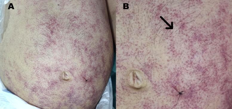 Two-panel clinical photograph (A and B) demonstrating a pathognomonic purpuric rash on the abdomen and flank of an immunocompromised patient with disseminated strongyloidiasis. Figure A provides a wide view of the torso, showing an extensive distribution of non-blanching, violaceous macules and small papules primarily concentrated in the periumbilical region, lower abdomen, and extending toward the flank. Figure B is a high-magnification view of the periumbilical area, highlighting specific morphological patterns. A black arrow indicates a classic 'thumbprint sign,' characterized by serpiginous and linear purpuric tracks caused by the subcutaneous migration of Strongyloides stercoralis filariform larvae (larva currens). The lesions appear as petechiae and ecchymoses with a distinctive reticulated or serpiginous arrangement. This finding is a critical clinical marker for Strongyloides hyperinfection syndrome or disseminated disease, often seen in the context of HIV infection or corticosteroid therapy.