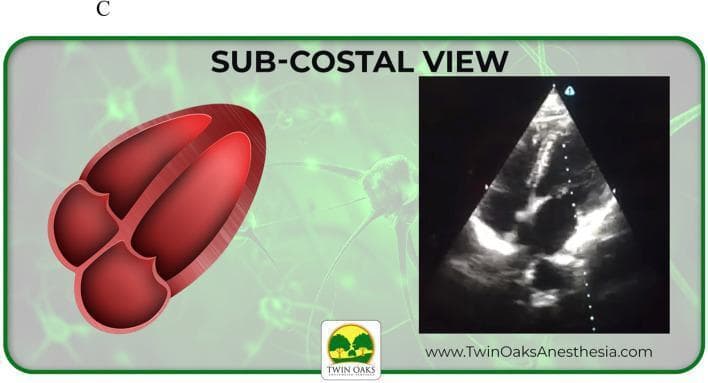 This educational graphic provides a side-by-side comparison of cardiac anatomy and sonographic representation in a subcostal transthoracic echocardiogram (TTE) view. On the left, an anatomical diagram illustrates a four-chamber view of the heart in cross-section, showing the left and right ventricles separated by the interventricular septum, along with the corresponding atria and atrioventricular valves. On the right, a corresponding grayscale echocardiogram (sonogram) in a sector scan format displays the heart from the subcostal acoustic window. The image highlights clinical landmarks including the hyperechoic (bright) ventricular walls and valves against the anechoic (dark) blood-filled chambers. This comparison is intended for medical trainees to correlate simplified anatomical models with real-time diagnostic imaging, specifically focusing on identifying cardiac chambers and orientation in the subcostal four-chamber view often used in emergency or critical care ultrasonography.