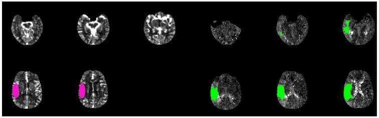 This diagnostic image series presents a Brain CT Perfusion (CTP) scan analyzed using automated software (RAPID) in the context of an acute ischemic stroke evaluation. The image displays multiple axial brain slices with color-coded overlays representing critical perfusion parameters. Areas highlighted in pink denote the 'infarct core,' where cerebral blood flow (CBF) is significantly reduced (<30%), indicating likely irreversible tissue damage. Areas highlighted in green represent the 'ischemic penumbra,' characterized by delayed contrast transit (Tmax > 6.0 s), indicating tissue at risk but potentially salvageable with reperfusion therapy. The spatial distribution of the green regions is notably larger than the pink regions, primarily involving the temporal, parietal, and frontal lobes of one hemisphere. This visual relationship demonstrates a 'favorable mismatch,' which is a key clinical indicator for determining a patient's eligibility for mechanical thrombectomy or thrombolytic treatment based on the mismatch ratio and volume.