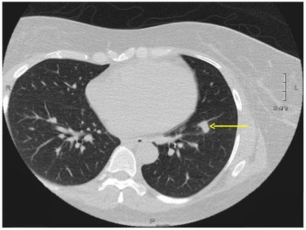 This diagnostic image is a transverse (axial) section of a non-contrast chest CT scan displayed in a lung window setting. The image provides a clear view of the thoracic cavity, including the lungs, mediastinum, heart, and posterior bony structures such as the spine and ribs. The primary pathology is a solitary pulmonary nodule located in the left lung lower lobe, indicated by a yellow arrow. The nodule is well-circumscribed, approximately 1.3 cm x 0.8 cm in size, and exhibits soft tissue density. The surrounding lung parenchyma appears largely unremarkable without evident ground-glass opacities, consolidation, or pleural effusion in the immediate vicinity. The branching vascular patterns and airways are visible within both lung fields. This visual is significant for medical education regarding the identification of incidental pulmonary findings, characterizing nodule morphology, and understanding the diagnostic approach to solitary pulmonary nodules in radiology and pulmonology.