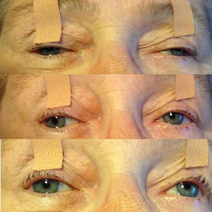 This clinical photograph consists of three vertically stacked snapshots of a patient's eyes, illustrating a complex pattern of ophthalmoplegia. The patient exhibits severe bilateral ptosis, necessitated by the use of medical tape to keep the upper eyelids elevated for examination. Close-up views reveal pupillary anisocoria, with the right pupil notably larger than the left, and a lack of reactivity. The sequence demonstrates multiple ocular motility deficits: the top and middle panels show weak adduction bilaterally, while the bottom panel highlights a right-sided upward gaze palsy where the right eye fails to elevate as effectively as the left. These findings are characteristic of brainstem involvement, specifically midbrain infarction affecting the oculomotor nerve nuclei and the medial longitudinal fasciculus (MLF), leading to bilateral internuclear ophthalmoplegia and internal ophthalmoplegia. The image serves as an educational tool for identifying neuro-ophthalmological signs associated with vertebrobasilar ischemia and Weber syndrome.