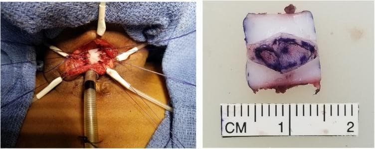 This composite clinical photograph illustrates key stages of a double-stage laryngotracheoplasty for grade III subglottic stenosis. The left image shows the intraoperative surgical field in the anterior neck region. Retractors and stay sutures are used to maintain exposure of a midline sagittal incision through the cricoid cartilage and proximal trachea. An autologous anterior costal cartilage graft, appearing as a white rectangular structure, is seen sutured into the laryngotracheal split to expand the airway lumen. A tracheostomy tube or laryngeal stent is visible inferior to the graft site. The right image is a close-up of the harvested and carved costal cartilage graft on a sterile back table. The graft is approximately 1.5 cm in length and 1 cm in width, as indicated by the adjacent centimeter ruler. It features a diamond-shaped purple surgical ink marking on its semi-translucent, whitish-blue surface to guide orientation and placement. This visual documentation highlights surgical techniques for pediatric airway reconstruction and graft preparation.