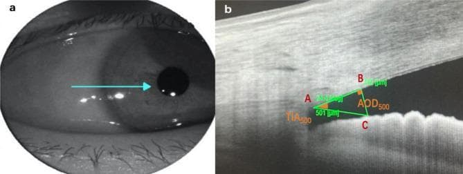 This dual-panel image demonstrates the methodology for quantifying anterior chamber angle (ACA) parameters using Swept-Source Anterior Segment Optical Coherence Tomography (AS-OCT). Panel A is an infrared clinical photograph of the eye, showing the horizontal scan line orientation directed toward the limbus. Panel B is a high-resolution AS-OCT cross-sectional scan of the iridocorneal angle. Key anatomical landmarks and measurements are annotated: Point A indicates the scleral spur, the primary reference point at the corneoscleral junction. The Anterior Opening Distance at 500 µm (AOD500) is illustrated by the vertical line segment B-C, measuring the distance from the corneal endothelium to the anterior iris surface. The Trabecular Iris Angle (TIA500) is shown as the vertex angle at point A, formed between the corneal and iris surfaces. These metrics are critical in ophthalmology for assessing glaucoma risk, characterizing angle closure, and evaluating physiological changes following surgical interventions like laser peripheral iridotomy.