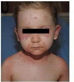 This clinical photograph shows the facial and upper chest region of a pediatric patient presenting with an extensive, symmetrically distributed dermatological eruption. The primary visual findings include a confluent, erythematous, and macular rash with an edematous appearance. The distribution is prominently periorbital (involving the infraorbital and malar areas) and perioral, with extension onto the cheeks and chin. Scattered erythematous macules are also visible on the forehead. The rash continues inferiorly onto the neck and upper chest, where it appears more diffuse and confluent. The skin in the affected areas shows signs of mild swelling without evident deep ulceration or mucosal involvement in the visible oral cavity. This clinical presentation is characteristic of systemic inflammatory or infectious processes such as Staphylococcal Scalded Skin Syndrome (SSSS), early Stevens-Johnson Syndrome (SJS), or toxic shock syndrome, where characteristic periorificial accentuation and superficial skin desquamation are common educational hallmarks.