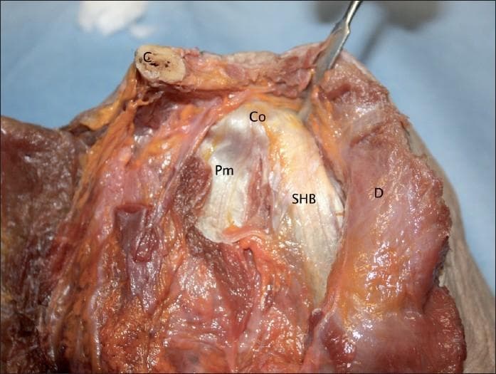 Anatomical dissection of a human cadaveric shoulder specimen focusing on the coracoid process (Co) and its associated muscular attachments. The image demonstrates the origin of the short head of the biceps brachii muscle (SHB) and the insertion of the pectoralis minor muscle (Pm). The short head of the biceps is shown with a broad, direct muscular attachment to the apex of the coracoid process, covered by a distinct white, fibrous tendinous aponeurosis on its anterior surface. The pectoralis minor tendon inserts onto the medial aspect of the coracoid process, adjacent but distinct from the SHB origin. Surrounding anatomical landmarks include the clavicle (C) positioned superiorly and the deltoid muscle (D) visible laterally. This clinical photograph provides high-resolution detail of the soft tissue relationships and aponeurotic structures critical for understanding shoulder anatomy and surgical approaches like the Latarjet procedure.