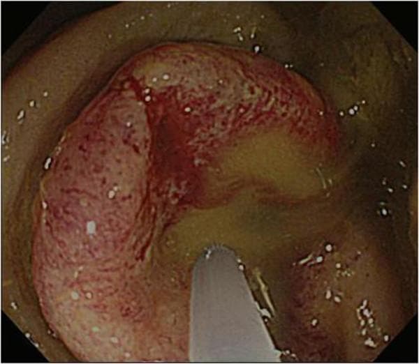 This endoscopic clinical image displays a colonoscopy view of the sigmoid colon, revealing an advanced, obstructive colorectal carcinoma. The pathology presents as a bulky, circumferential mass that causes severe luminal stenosis, nearly completely occluding the intestinal passage. The tumor surface is markedly irregular and nodular, exhibiting a predominantly pinkish-red color with dark red hyperemic patches suggestive of friability and potential hemorrhage. Areas of yellowish-tan discoloration are visible on the mass, which may indicate surface necrosis or mucinous components. Surrounding the lesion, the lumen contains yellowish-brown, translucent fluid with small air bubbles and suspended particulate matter. The image illustrates a critical case of obstructive colitis, highlighting the characteristic morphology of a moderately differentiated adenocarcinoma in a geriatric clinical context.