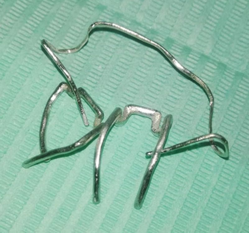 A clinical procedural image displaying orthodontic clasp components fabricated using Selective Laser Melting (SLM) technology. The metallic assembly, likely composed of a Cobalt-Chromium (Co-Cr) alloy, is shown in a post-manufacturing state after the removal of support structures. The components include elements of an Adams clasp—specifically the bridge, arrowheads, and retention tags—interconnected with a labial bow wire form. The metallic surface exhibits a semi-matte, silver-colored finish with a slightly granular texture characteristic of 3D-printed dental alloys before final electropolishing. These components are designed to provide retention for a Hawley retainer, with the arrowheads positioned to engage dental undercuts and the tags intended for embedding into an acrylic baseplate. This image demonstrates the application of additive manufacturing in digital orthodontics for the creation of precise, custom dental appliances.