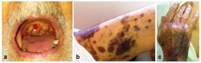 This composite clinical photograph displays dermatologic and mucosal manifestations of severe thrombocytopenia, likely secondary to immune thrombocytopenic purpura (ITP) in the context of COVID-19. Panel (a) shows the oral cavity with prominent hemorrhagic bullae (wet purpura) on the soft palate and oropharynx, presenting as blood-filled, tense blisters. Panel (b) illustrates the lower extremity featuring multifocal, scattered ecchymoses and petechiae, varying in color from reddish-purple to dark brown, reflecting different stages of extravasated blood. Panel (c) demonstrates confluent purpura on the dorsum of the hand, where the skin appears extensively bruised and darkened. These visual findings are classic indicators of a high risk for life-threatening bleeding due to profoundly low platelet counts. The images provide critical educational examples of mucocutaneous bleeding signs that necessitate urgent hematological evaluation.