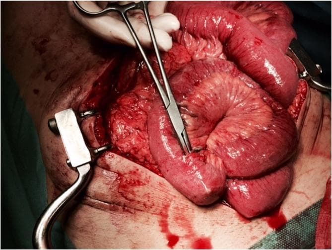 This clinical photograph captures an intraoperative view during an emergent laparotomy for blunt abdominal trauma. The image shows a loop of small bowel (jejunum/ileum) exteriorized through a midline incision. A surgical clamp (hemostat) is positioned to identify and isolate a traumatic perforation located at the mesenteric border of the intestine. The affected bowel segment appears hyperemic and erythematous (reddish-pink), with a moist, glistening serosal surface. Visible within the surgical field are self-retaining retractors maintaining the abdominal opening, along with surrounding skin and subcutaneous tissue. Areas of localized hemorrhage are visible on the serosa and within the mesentery, consistent with high-energy blunt trauma. The image serves as a clinical demonstration of a Grade II small bowel injury and highlights the surgical challenge of identifying mesenteric-side perforations compared to more visible antimesenteric lesions.