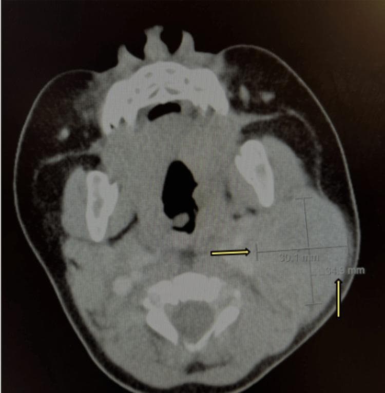 This diagnostic image is an axial contrast-enhanced computerized tomography (CT) scan of the neck at the level of the mandible and cervical vertebrae. The image demonstrates a large, ill-defined, heterogeneous mass located in the left anterior cervical region. Yellow arrows and electronic calipers highlight the lesion, providing cross-sectional measurements of 30.1 mm and 34.9 mm. The mass exhibits non-uniform internal density with areas of heterogeneous enhancement, suggesting internal necrosis, inflammation, or complex tissue composition. Anatomically, the lesion causes significant effacement of the surrounding soft tissue planes and exerts a mass effect on adjacent structures. Educational focus includes the radiologic evaluation of neck masses and the differential diagnosis of cervical lymphadenopathy, which may include neoplasia, infectious lymphadenitis with central necrosis, or inflammatory processes. This material is suitable for radiology and otolaryngology medical education for students and residents learning to interpret cervical CT pathology.