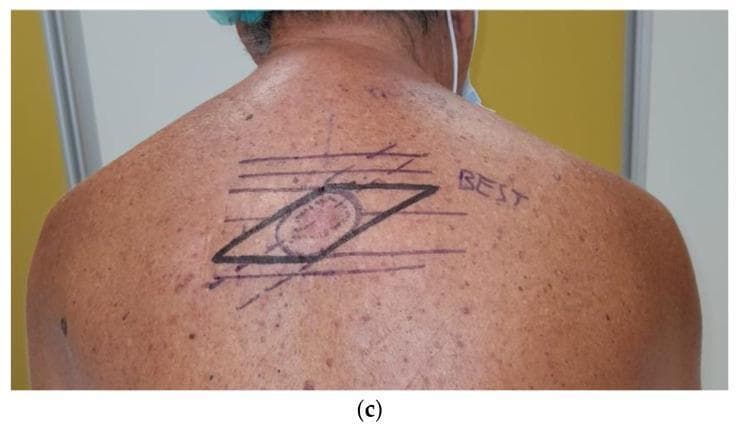 A clinical photograph of the upper back of a 67-year-old male demonstrating advanced preoperative surgical markings for the wide local excision of a malignant melanoma. The central focus is a pigmented skin lesion circumscribed by an elliptical marking. Surrounding this ellipse is a larger, prominent parallelogram drawn in black ink. This 'parallelogram excision' technique is a reconstructive surgical approach used when the lesion's major axis is not parallel to Relaxed Skin Tension Lines (RSTLs). The markings include multiple horizontal lines labeled as 'BEST' lines (Biodynamic Excising Skin Tension), which guide the orientation of the excision to optimize wound closure and minimize 'dog-ear' deformities. Diagonal tangent lines intersect the horizontal BEST lines to form the vertices of the parallelogram. The surrounding skin shows solar lentigines and diffuse actinic damage, typical for the patient demographic and clinical context of cutaneous melanoma.