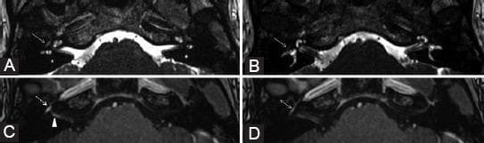 This diagnostic image set consists of four axial MRI sections (A-D) focusing on the skull base and internal auditory canals to evaluate cranial nerve VII (facial nerve). Panels A and B are axial 3D FIESTA (Fast Imaging Employing Steady-state Acquisition) images, which reveal a subtle signal hyperintensity at the tympanic segment of the right facial nerve (indicated by arrows). Panels C and D are contrast-enhanced 3D T1-weighted images demonstrating a pathological, uniformly linear enhancement involving the right geniculate ganglion (dashed arrow), canalicular segment (arrowhead), and tympanic segment (double arrow). When compared to the contralateral left side, the right facial nerve shows markedly increased contrast uptake without significant nerve thickening. These findings are characteristic of neuritis, involving multiple intratemporal segments of the facial nerve, consistent with a clinical presentation of acute peripheral facial nerve paralysis. The imaging modality provides high-resolution anatomical detail of the cisterns and nerve pathways within the petrous temporal bone.