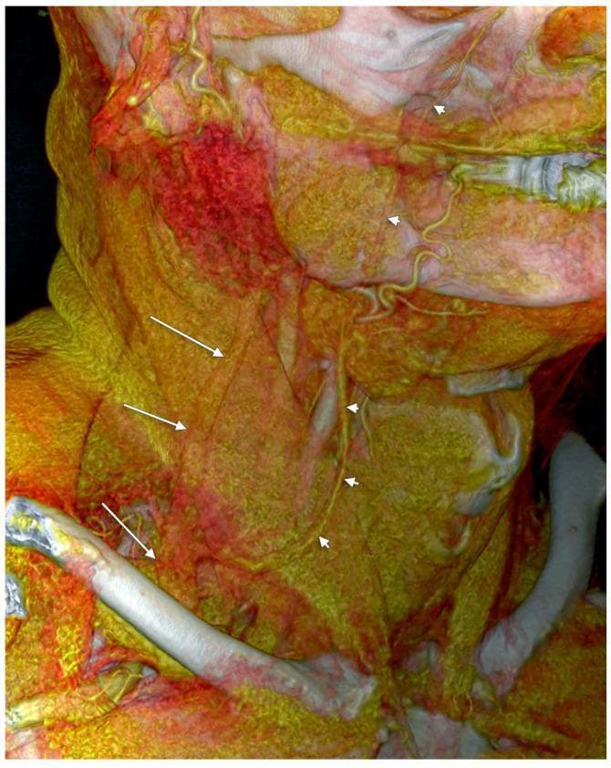 This diagnostic image is a 3D volume-rendered (3D-VR) reconstruction of a right antero-lateral view of the human neck, highlighting a vascular anatomical variant. The visualization depicts the superficial venous system in relation to the sternocleidomastoid muscle (SCM). The external jugular vein (EJV), indicated by thin white arrows, is shown descending obliquely across the surface of the SCM. A prominent facial vein, marked by white arrowheads, courses anteriorly and inferiorly across the neck. Rather than following a standard drainage pattern into the internal jugular vein, the facial vein is seen terminating as a major tributary into the lower segment of the EJV within the supraclavicular triangle. This specific configuration is classified as a 'false duplication' of the external jugular vein, as the two vessels run parallel before merging, superficially resembling a bifurcated system. The image serves as an educational resource for identifying anatomical variations in cervical venous anatomy, which is critical for surgical planning, central venous catheterization, and avoiding complications during neck dissections.