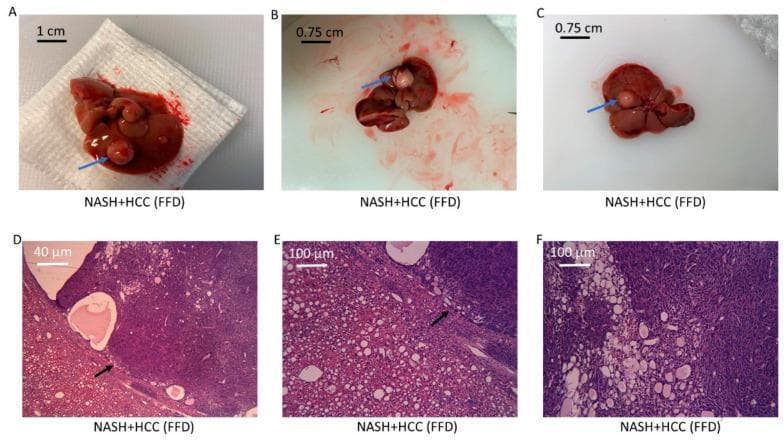 Educational visual showing the progression of Non-Alcoholic Steatohepatitis (NASH) to Hepatocellular Carcinoma (HCC) through gross and microscopic pathology. Panels A-C are clinical photographs of liver specimens from a research model, displaying distinct polyp-like, exophytic tumor growths (blue arrows) on a reddish-brown liver surface. Panel D-F show Hematoxylin and Eosin (H&E) stained sections at various magnifications (scale bars: 40 μm and 100 μm). The histology reveals a clear transition margin (black arrows) between noncancerous parenchyma and the malignant tumor. Key histopathological features include a trabecular growth pattern of atypical hepatocytes, significant macrovesicular steatosis (lipid vacuoles), inflammation, and clusters of hyperchromatic nuclei. This comparison illustrates the typical morphological changes and architectural distortion seen in NASH-associated liver cancer, highlighting the diagnostic criteria for differentiating steatotic liver tissue from neoplastic growth.