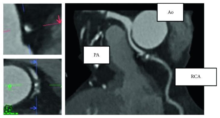 This diagnostic image consists of a large multiplanar reconstruction (MPR) and two smaller magnified views from a coronary computed tomography angiography (CCTA). The primary image demonstrates the spatial relationship between the aorta (Ao), pulmonary artery (PA), and the right coronary artery (RCA). The RCA is shown originating and coursing between the large circular aorta and the adjacent pulmonary artery. Pathological findings characteristic of atherosclerosis are highlighted within the RCA, specifically showing spotty calcification—indicated by focal, high-attenuation (bright) deposits within the vessel wall—and evidence of mild positive remodeling, characterized by a localized outward expansion of the arterial wall diameter at the site of the lesion. The magnified panels on the left provide detailed cross-sectional and longitudinal views of these atherosclerotic changes, emphasizing the eccentric plaque and calcified elements. This clinical image is used in cardiology to evaluate coronary artery anomalies and the morphological characteristics of coronary plaques in the context of ischemic heart disease.