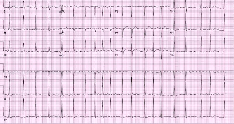 This diagnostic image is a 12-lead electrocardiogram (ECG) printed on standard pink grid paper, demonstrating atrial fibrillation (AF) with a rapid ventricular response (RVR). The tracing shows the standard 12 leads (I, II, III, aVR, aVL, aVF, V1-V6) in a multi-channel format, with three continuous rhythm strips (V1, II, and V5) at the bottom. Key diagnostic features include the absolute absence of organized P waves and an irregular, undulating fibrillatory baseline most prominent in lead V1. The ventricular rhythm is tachycardic and 'irregularly irregular,' characterized by varying R-R intervals. The QRS complexes are narrow (less than 120 ms), indicating supraventricular origin of conduction through the AV node. ST segments are generally isoelectric without acute ST-elevation or depression. This ECG is a classic clinical representation used to teach cardiac arrhythmia recognition, specifically the hemodynamic and electrical manifestations of AF with uncontrolled rapid heart rate.
