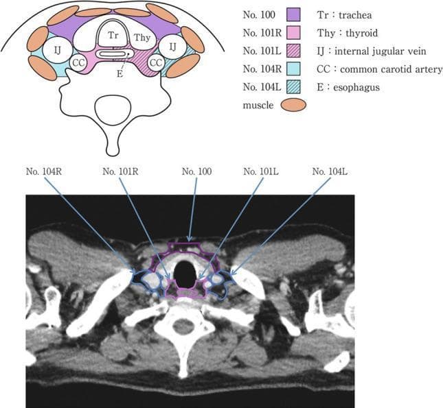 This educational graphic consists of a diagnostic CT image and a corresponding anatomical diagram illustrating cervical lymph node stations in the axial plane at the level of the thyroid gland. The anatomical diagram (top) uses color-coded regions and labels to identify the trachea (Tr), thyroid (Thy), internal jugular veins (IJ), common carotid arteries (CC), and esophagus (E). The accompanying legend classifies specific nodal stations: No. 100 (superficial cervical), No. 101R/L (upper esophageal/paratracheal), and No. 104R/L (supraclavicular). The axial CT scan (bottom) displays these anatomical structures in situ with corresponding color-coded overlays and pointers that map the nodal station classification onto the clinical image. The trachea is centrally located, anterior to the collapsed esophagus and vertebral body. The thyroid lobes flank the trachea, while the carotid sheaths containing the common carotid arteries and internal jugular veins are positioned laterally. This resource is designed for surgical oncology and radiology education, specifically for staging esophageal cancer and identifying cervical lymph node zones.