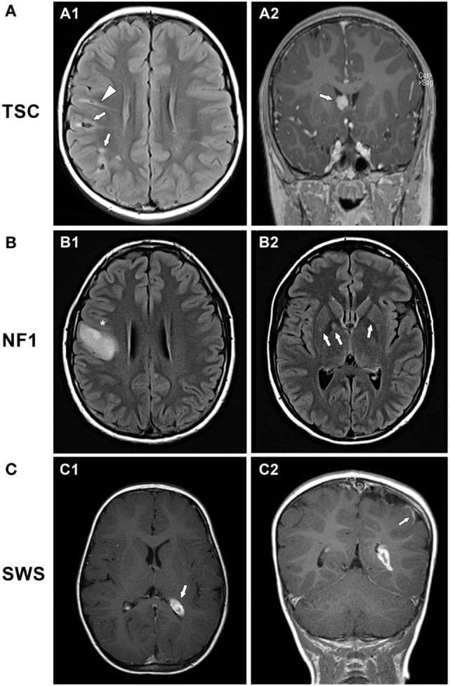 This composite of diagnostic images presents magnetic resonance imaging (MRI) findings across three major neurocutaneous syndromes: Tuberous Sclerosis Complex (TSC), Neurofibromatosis Type 1 (NF1), and Sturge–Weber Syndrome (SWS). Section A (TSC) displays axial FLAIR and coronal contrast-enhanced T1 images showing multiple cortical and subcortical tubers in the right frontoparietal lobes, characterized by mixed signal intensity and linear FLAIR-hyperintense migration lines. A round, enhancing subependymal giant cell astrocytoma (SEGA) is visible at the right foramen of Monro. Section B (NF1) includes axial FLAIR and T1 images demonstrating a large, hyperintense, expansile low-grade glioma in the right precentral gyrus, along with focal T2/FLAIR hyperintensities (unidentified bright objects or UBOs) in the basal ganglia, specifically the globus pallidus and putamen. Section C (SWS) utilizes post-contrast T1-weighted axial and coronal views to illustrate left hemispheric atrophy, prominent enhancement of the choroid plexus glomus, and classic leptomeningeal angiomatosis enhancement in the parieto-occipital region. The collection serves as an educational comparison of hallmark intracranial manifestations and pathognomonic lesions associated with phakomatoses.
