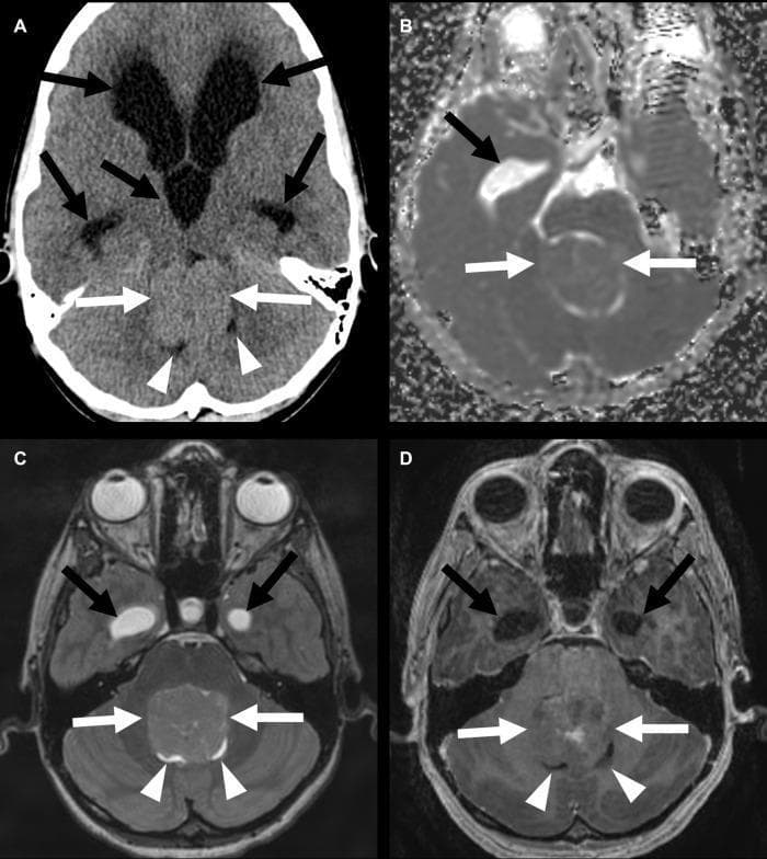 This composite diagnostic image features axial views of the brain of a 12-year-old male with a posterior fossa group B ependymoma. Image (A) is a non-contrast head CT demonstrating a midline posterior fossa mass (white arrows) without internal calcification. There is significant mass effect causing almost complete effacement of the fourth ventricle (arrowheads) and obstructive supratentorial hydrocephalus with dilation of the lateral ventricles (black arrows). Image (B) is an Apparent Diffusion Coefficient (ADC) map showing no signs of restricted diffusion. Image (C) is a T2-weighted MRI where the mass appears isointense to the adjacent cerebral cortex. Image (D) is a contrast-enhanced MRI showing the tumor's heterogeneous enhancement pattern. In all MRI sequences (B-D), the effacement of the fourth ventricle and the secondary hydrocephalus (dilated temporal horns of the lateral ventricles, black arrows) are clearly visible. These findings illustrate the typical radiographic presentation of a posterior fossa ependymoma and its common complications, specifically cerebrospinal fluid flow obstruction.
