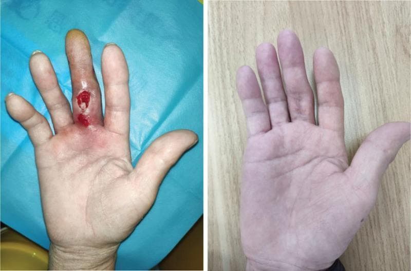 This clinical photograph set comprises two panels (A and B) comparing the presentation and resolution of a severe soft tissue infection on the right hand of a patient with type 2 diabetes. Panel A (Left) displays the palm and fingers during hospital admission, showing acute inflammatory signs localized to the middle finger. Findings include marked fusiform swelling, erythema, and a deep, irregular open wound over the proximal and middle phalanges with visible granulation tissue and purulent exudate. The distal aspect of the finger exhibits yellowish discoloration, suggesting impaired perfusion or advanced infection (pyogenic tenosynovitis). Panel B (Right) shows the same hand at a three-month follow-up after surgical debridement and targeted antibiotic therapy (Vancomycin). The image demonstrates complete resolution of edema and erythema, with a well-healed surgical scar on the volar surface of the middle finger and restoration of normal skin integrity and color. This comparison illustrates the clinical progression from an infected hand wound, complicated by Streptococcus gordonii, to successful recovery.